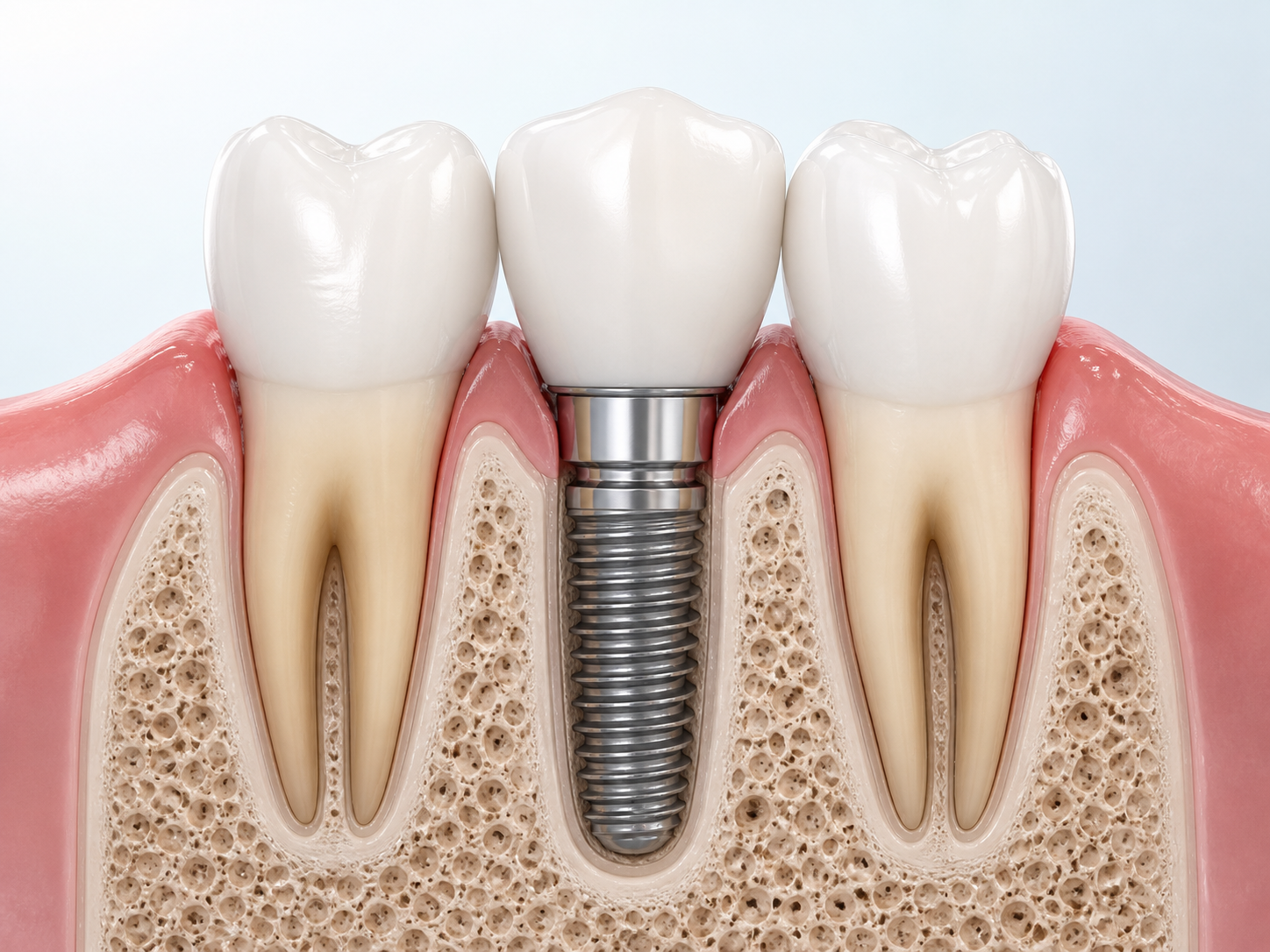 Ilustración de un implante dental entre dos piezas naturales